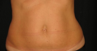 how-much-coolsculpting-cost