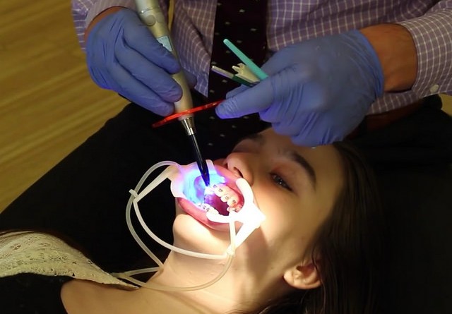 how-much-does-teeth-whitening-cost